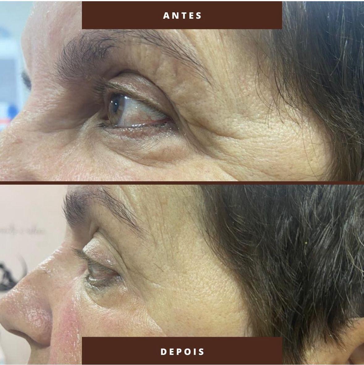 Botox — antes e depois face