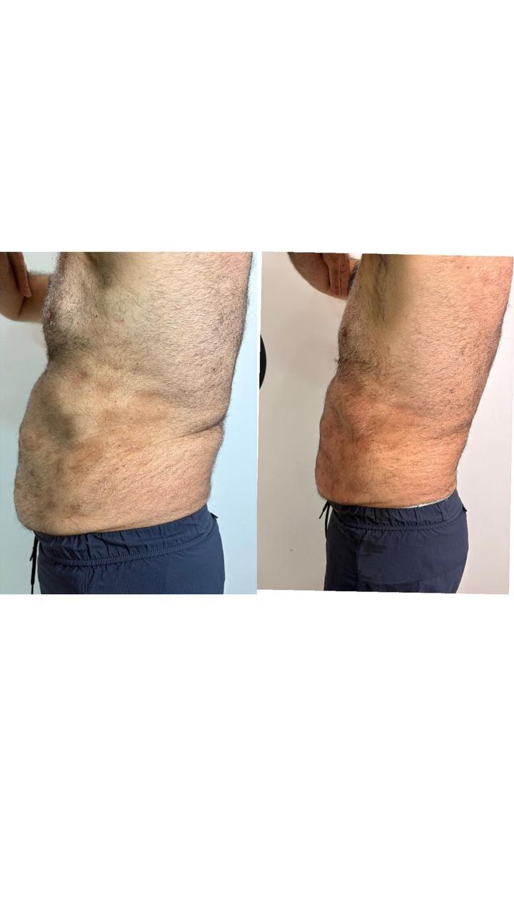 Criolipólise abdominal masculino
