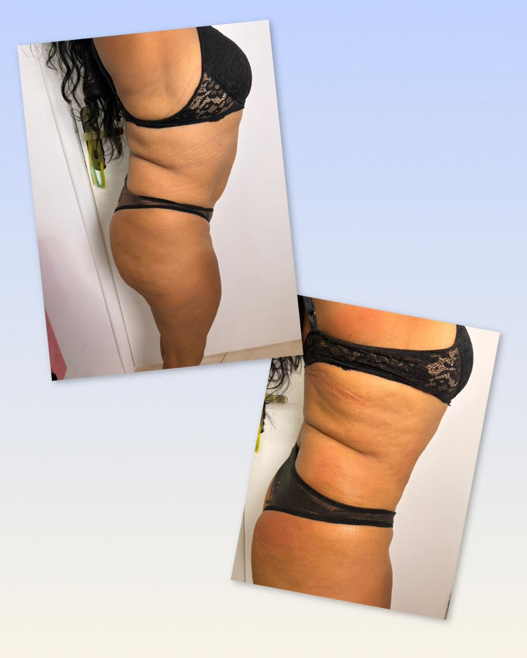 Criolipólise — antes e depois corpo feminino