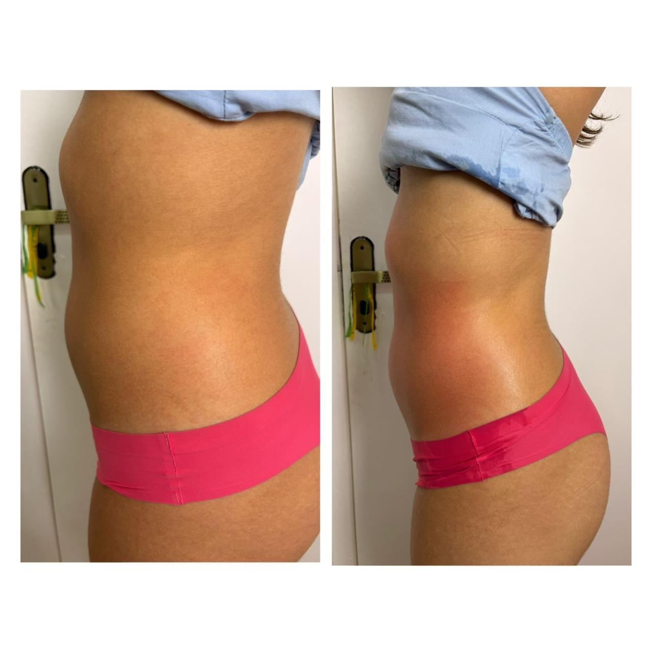 Criolipólise lateral feminino