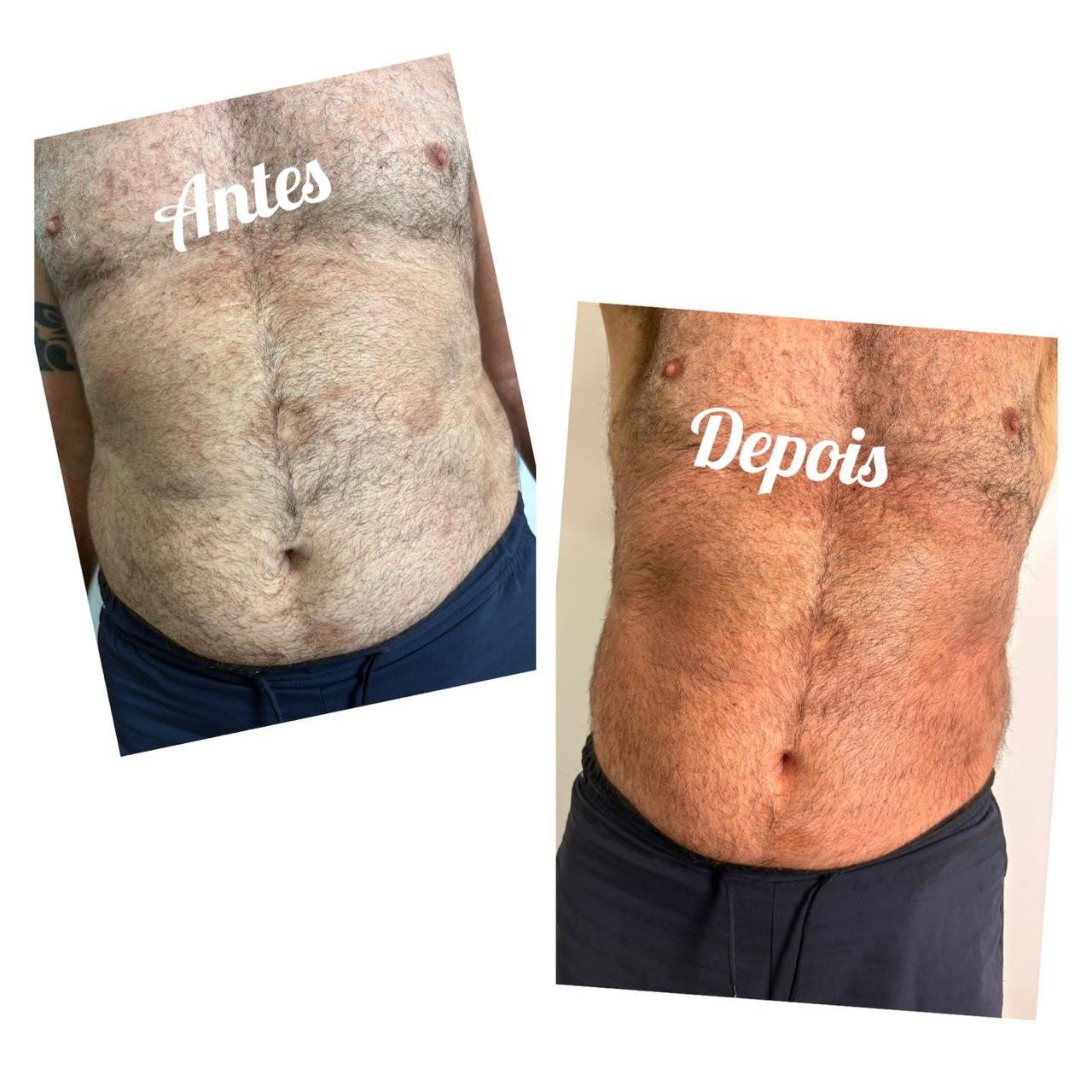 Criolipólise masculino