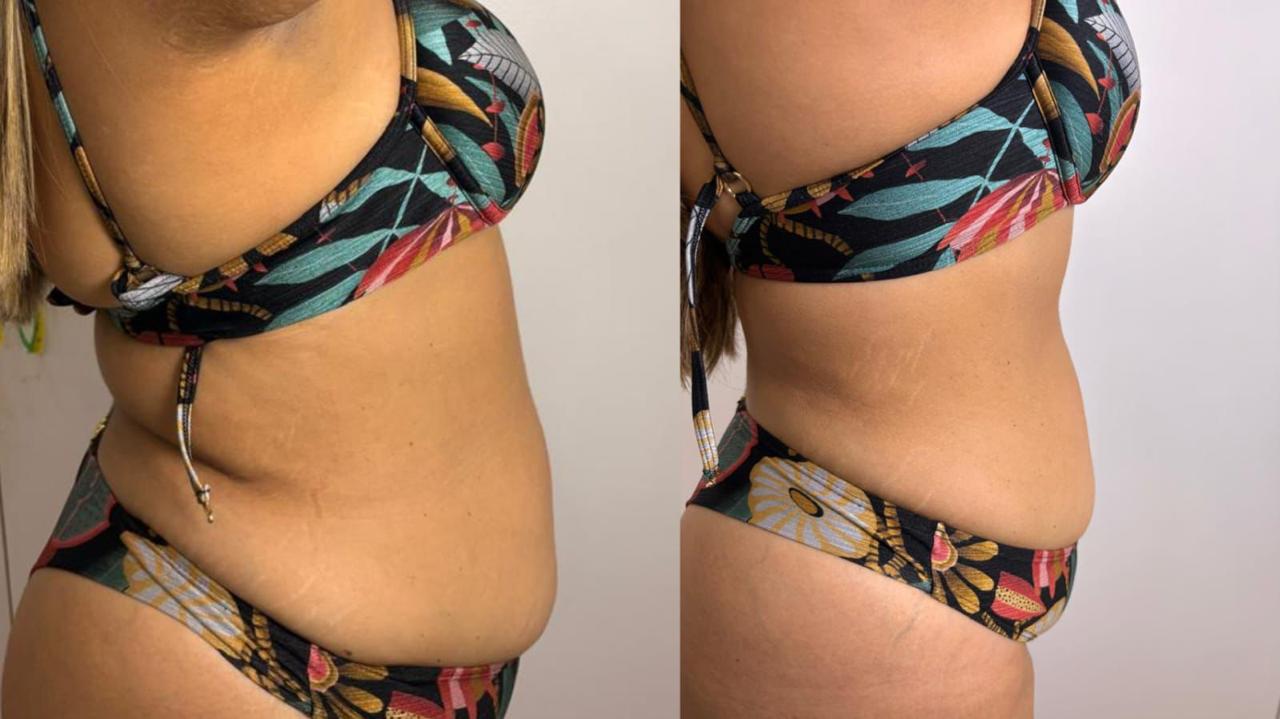 Antes e depois corpo feminino — lateral